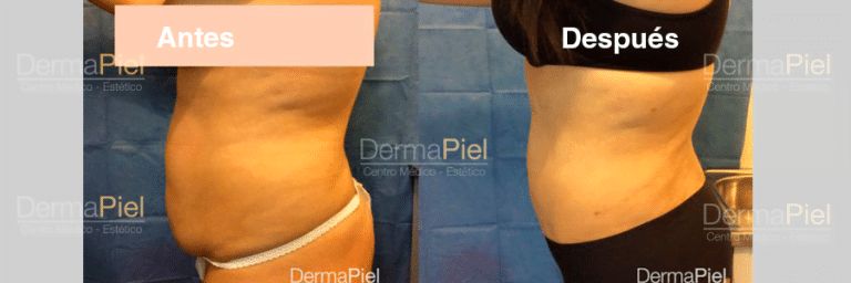 Liposuccion de Pubis
