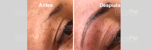 Microblading