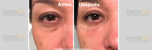 Relleno de Ojeras antes y despues