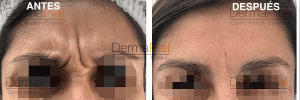 botox antes y despues dermapiel