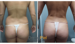 antes y despues liposuccion ambulatoria