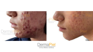 tratamiento Acne