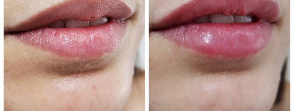 antes y despues relleno de labios acido hialuronico