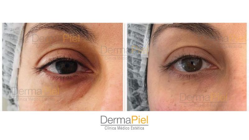 Relleno de Ojeras - Imagen 5