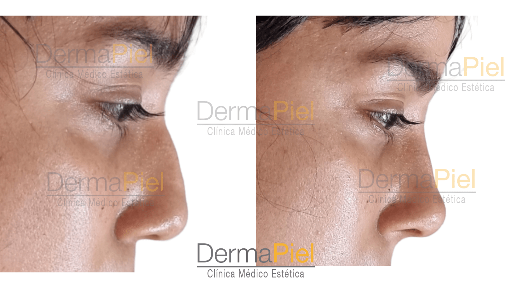 Dermapiel antes y despues de rellenos faciales con acido hialuronico