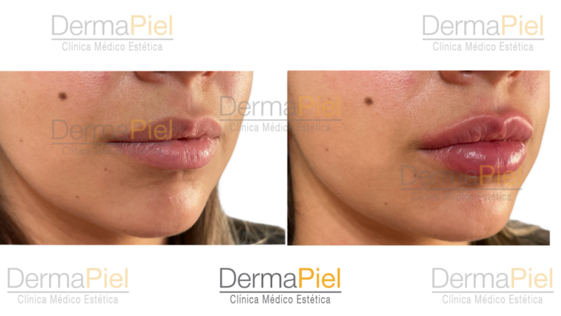 Relleno De Labios - Imagen 3
