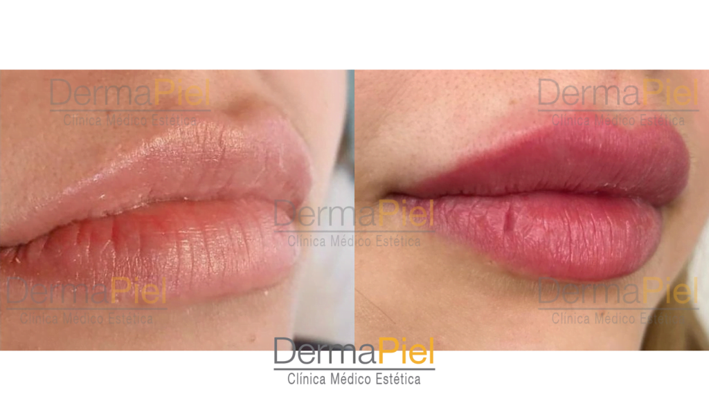 Relleno De Labios - Imagen 5