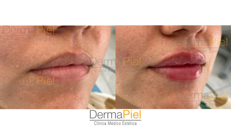 Relleno De Labios - Imagen 2