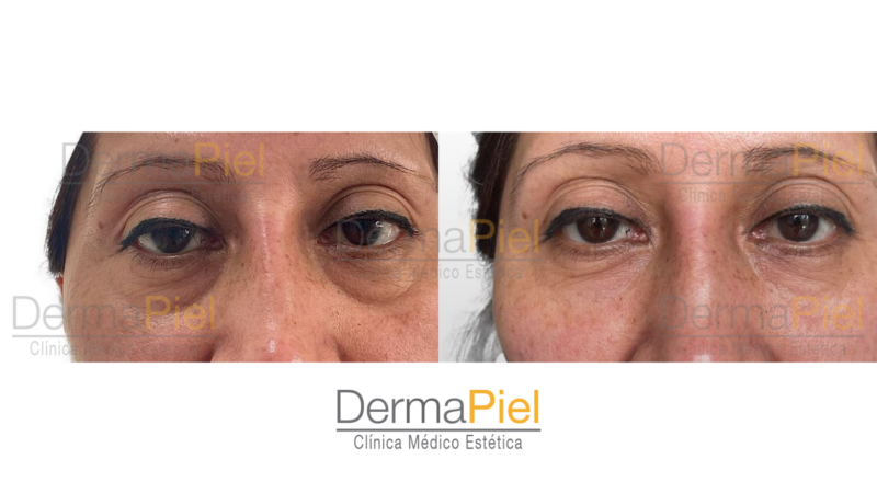 Relleno de Ojeras - Imagen 3