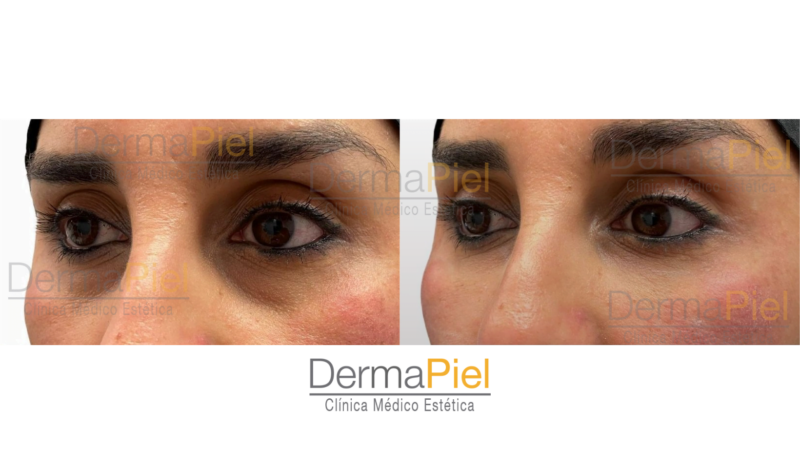 Relleno de Ojeras - Imagen 2