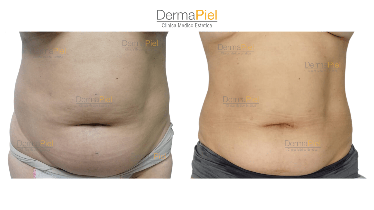 Hidrolipoclasia - Tratamiento Reductivo en Santiago - Dermapiel