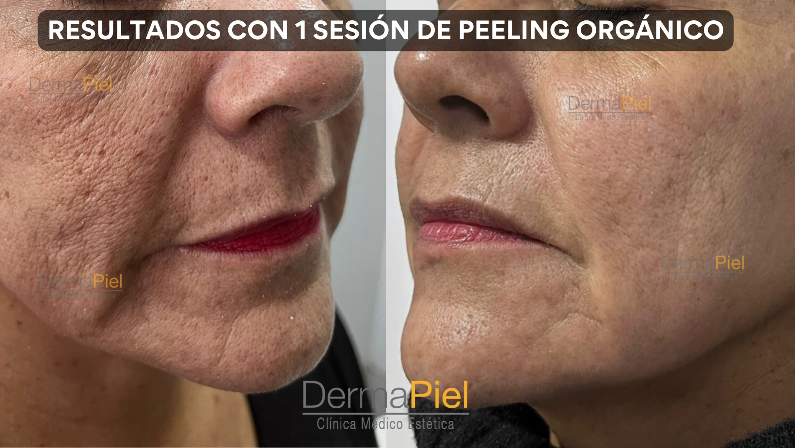 PEELING ORGÁNICO