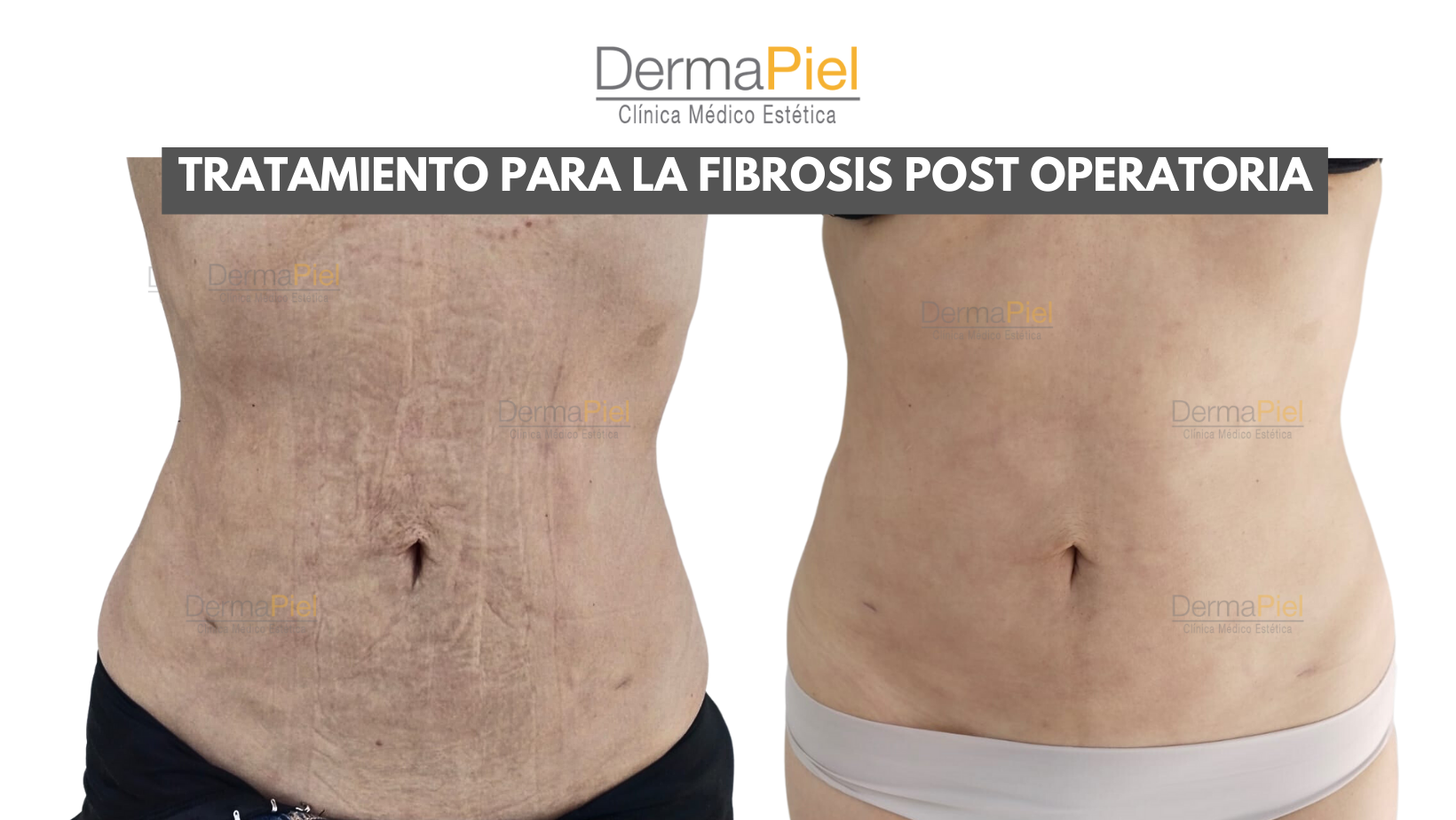 FIBROSIS POST OPERATORIA ANTES Y DESPUÉS