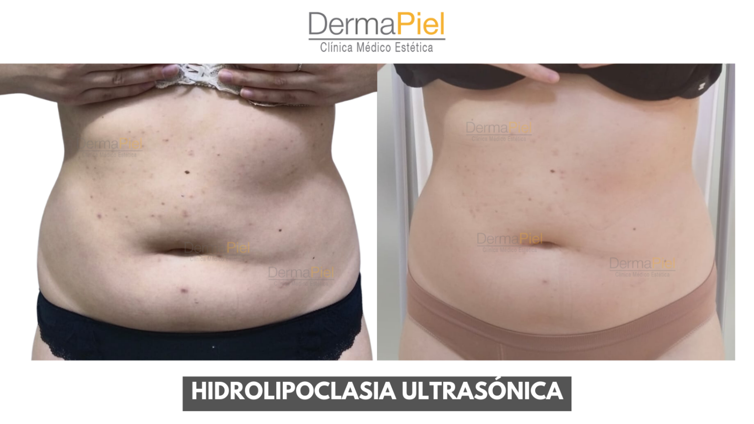 Hidrolipoclasia - Tratamiento Reductivo en Santiago - Dermapiel