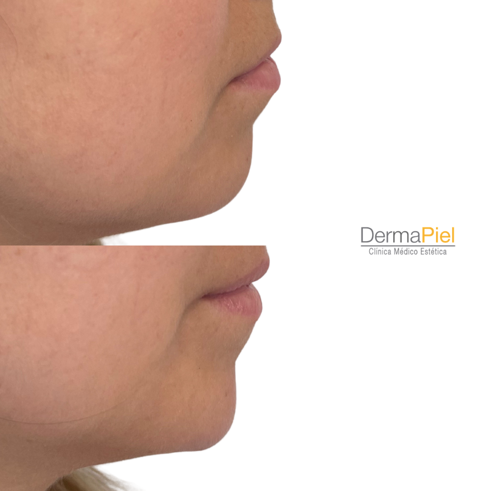 Relleno de Mandíbula y Mentón