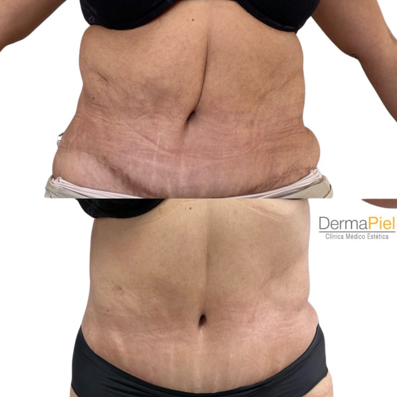 Fibrosis Post Operatoria