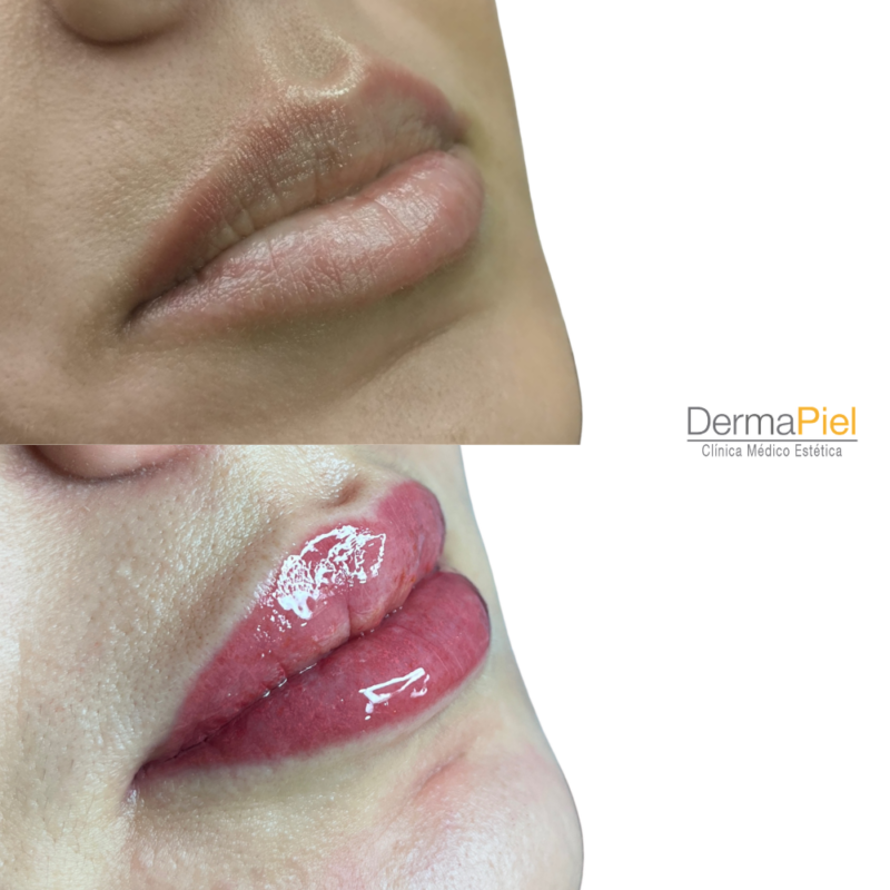 Micropigmentación de Labios