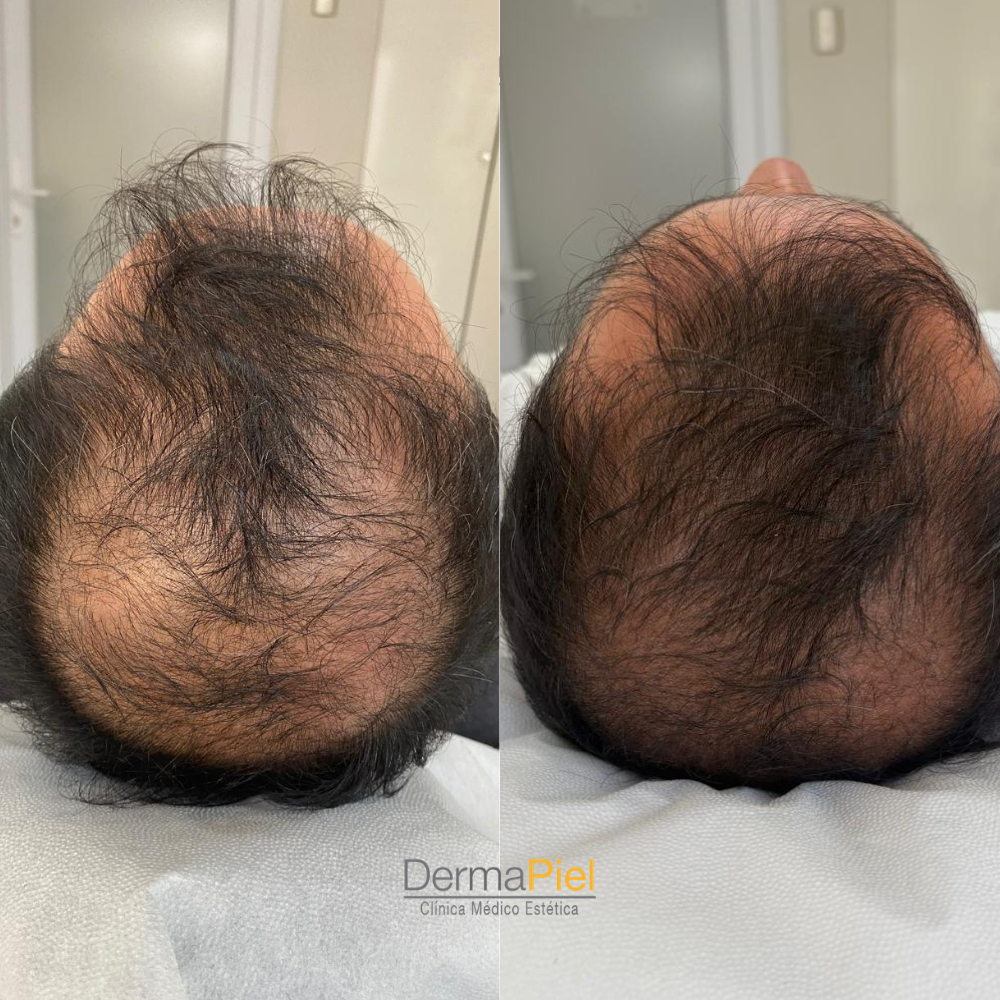 Plasma Rico en Plaquetas Ultra Premium