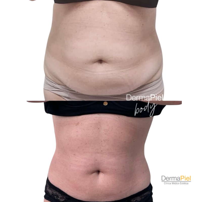 Tratamiento de Hidrolipoclasia