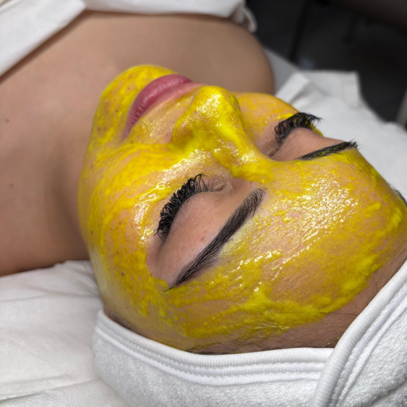 Tratamiento Peeling ácido Retinoico