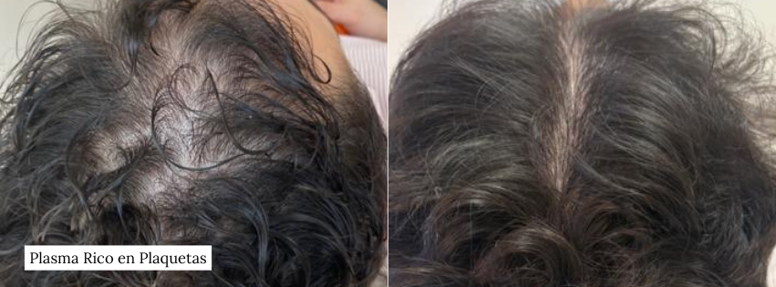 PRP caida de cabello / alopecia